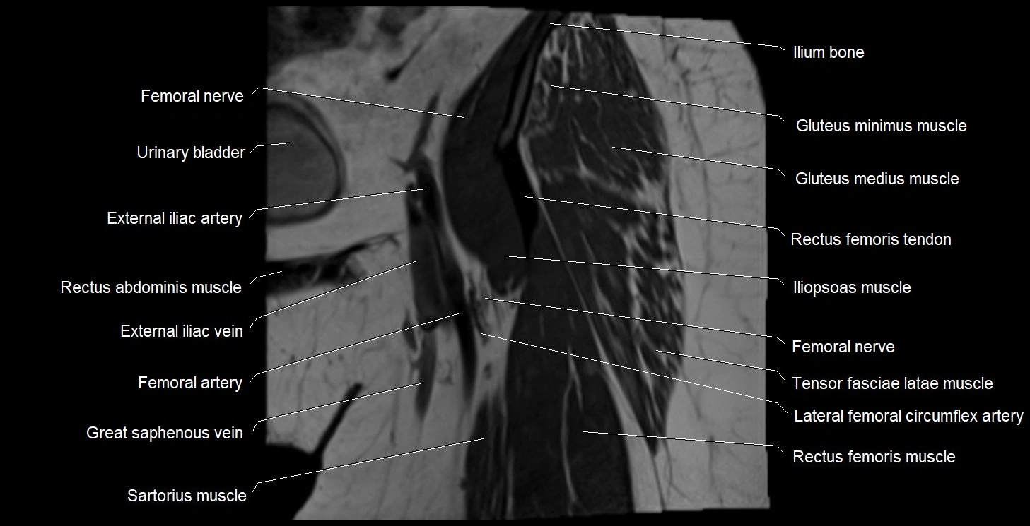 MRI Hip 3T coronal cross sectional anatomy image 10.webp